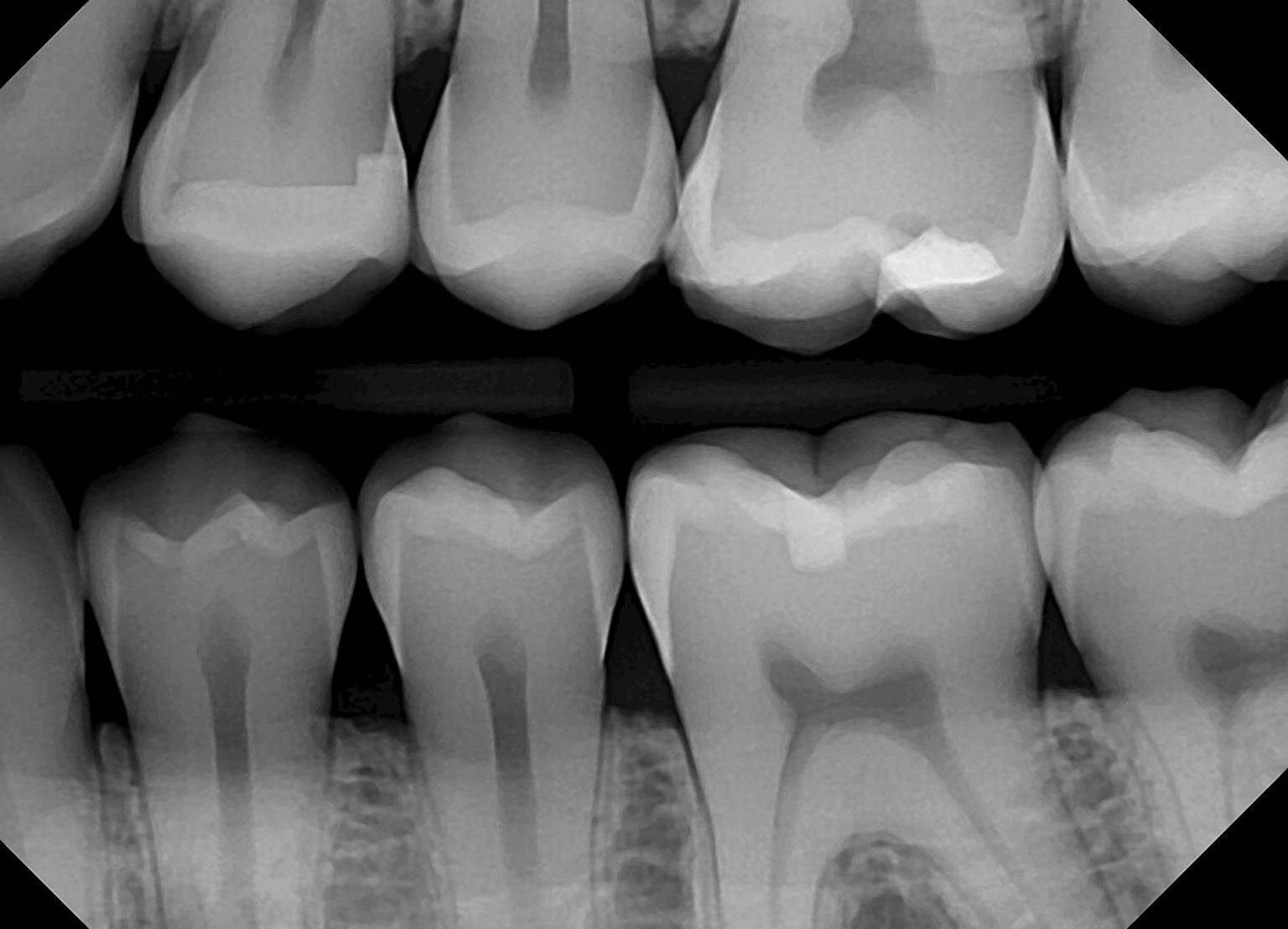 Xray image captured with the DentiMax Dream Sensors. Infinity Infinity
